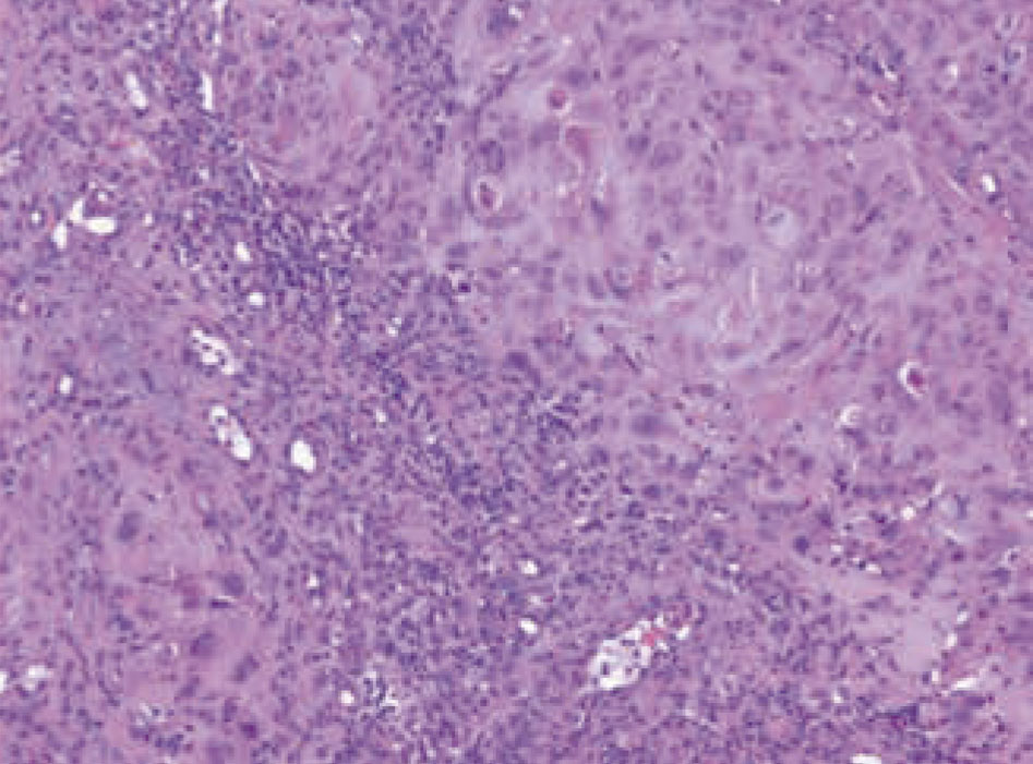Figura 5 – Biopsia de la lesión cutánea: metástasis dérmica de carcinoma escamoso pobremente diferenciado con abundantes figuras de mitosis.