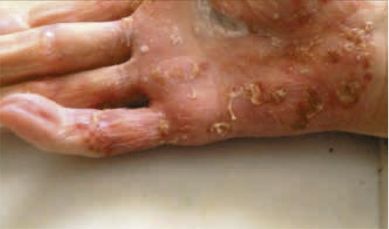 Figura 2 – Lesiones en mano derecha. 