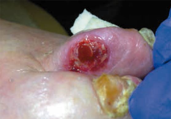 Figura 3 – Lesiones en pie izquierdo.