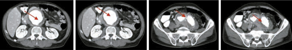 Figura 3 – TAC tóraco-abdominal sin y con contraste: aneurisma de la aorta abdominal que comienza por debajo de la arteria renal izquierda y se extiende a ambas ilíacas comunes con trombo mural.