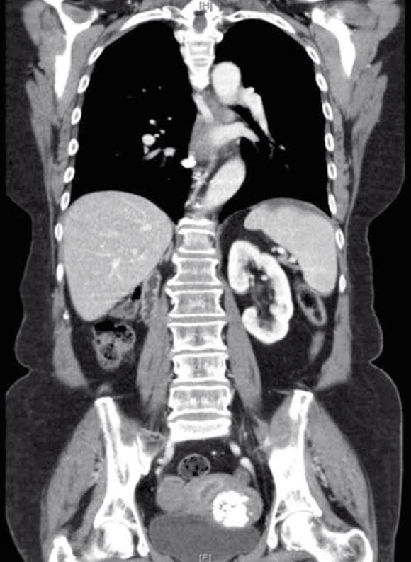 Figura 5 – TC abdomen superior y pelvis postcirugía sin y con contraste: Hígado morfología y ecoestructura normal, dos quistes el mayor de 15 mm. Bazo, glándulas suprarrenales, páncreas, riñón izquierdo, estructuras óseas y aorta abdominal normales. Ausencia de riñón derecho No adenopatías locorregionales.