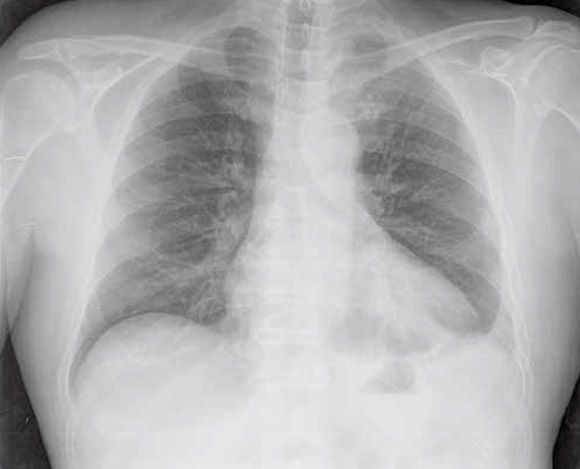 Figura 1 – Radiografía anterioposterior de tórax.