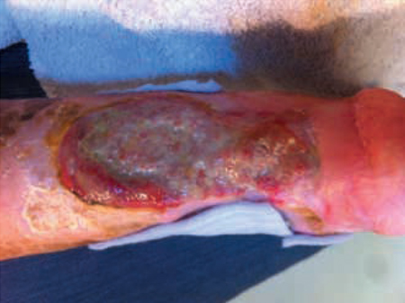 Figura 4 – Úlcera desbridada.