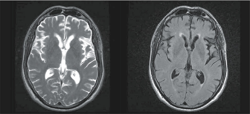 Figura 1 – RM cerebral: leucoencefalopatía secundaria a vasculopatía de pequeño vaso. Cambios atrpófico involutivos leves, de predominio temporal.
