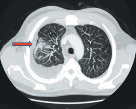 Figura 2 – TAC de tórax (ventana pulmonar): se aprecia derrame pleural derecho de moderada cuantía y características atípicas, junto con un aumento de densidad localizada en el lóbulo superior derecho (flecha roja). 