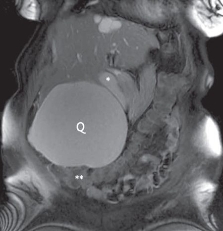 Figura 3 – Imagen coronal de la resonancia magnética en secuencia T2 con saturación grasa: se aprecia el desplazamiento medial de la vesícula biliar (*) y caudal del colon trasverso (**) por el efecto expansivo del quiste hepático (Q) en su crecimiento.