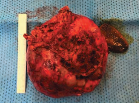Figura 4 – Detalle quirúrgico del quiste hepático: simulación in situ de su volumen en comparación con una vesícula biliar de apariencia normal.