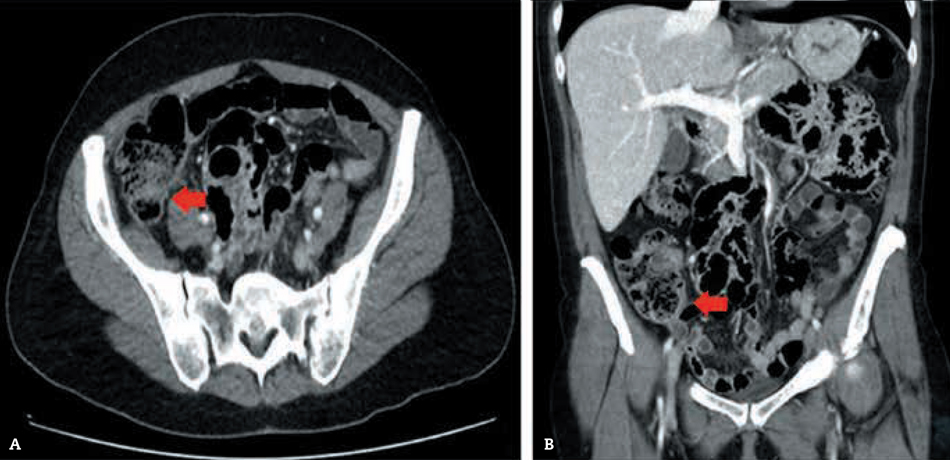 Figura 3 – Resolución del proceso inflamatorio agudo pericecal y ausencia del apendicolito en la TC abdominal de control (flechas), en referencia al mismo corte axial (A) y coronal (B) de los estudios tomográficos previos.