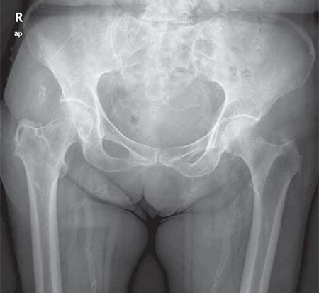 Figura 1 – Radiografía anteroposterior de cadera.
