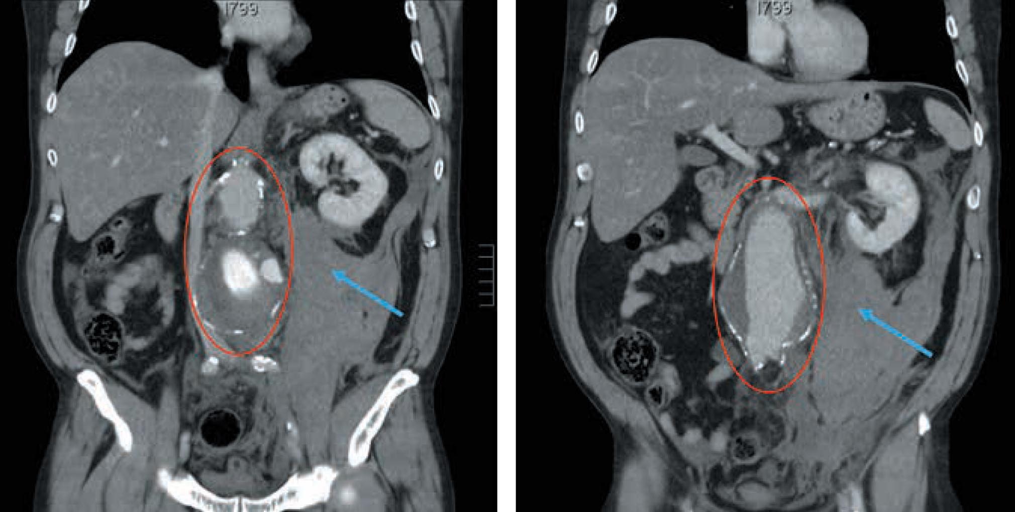 Figura 1 – Cortes frontales de TC de abdomen con contraste: se observa un aneurisma de aorta infrarrenal, parcialmente trombosado (circunferencia roja), así como un importante hematoma retroperitoneal (flecha azul). 