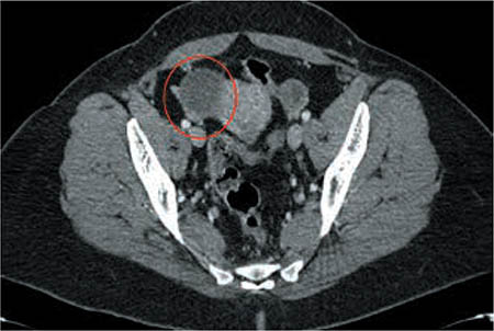 Figuras 2 – TAC abdómino-pélvica: masa de aproximadamente 4 x 4,5 cm, adyacente al útero y cerca de su cuerno superior derecho, en la teórica zona del ovario derecho, compatible con sospecha clínica de endometriosis.