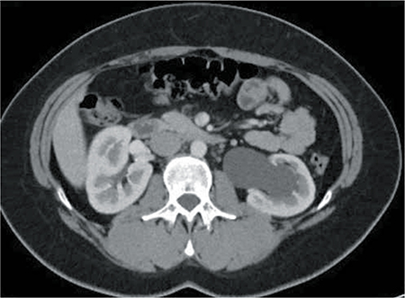 Figura 2 – UroTAC: marcada ureterohidronefrosis izquierda.