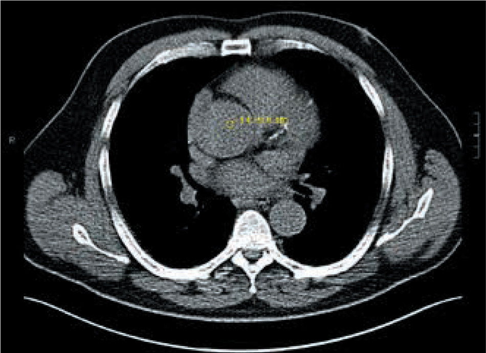 Figura 1 – Aneurisma de la aorta ascendente (5,4 cm).