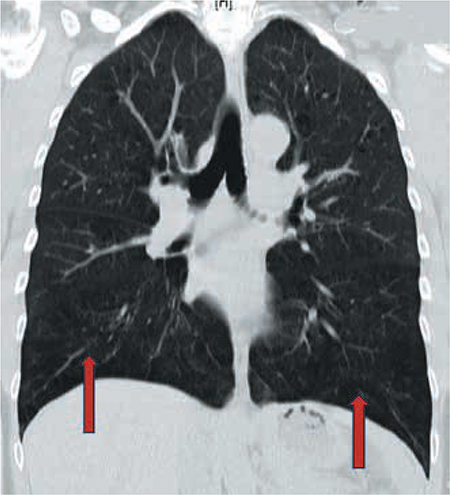 Figura 2 –  TAC de tórax (ventana pulmonar). Se evidencian signos de enfisema panacinar en ambas bases  (flechas rojas).