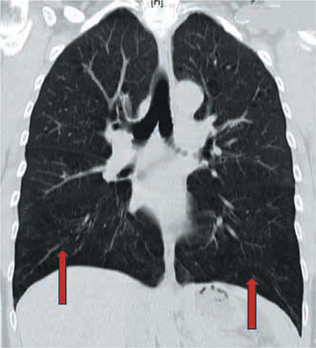 M s All De La Enfermedad Pulmonar Obstructiva Cr nica Medicina M s All De La Enfermedad Pulmonar Obstructiva Cr nica Medicina