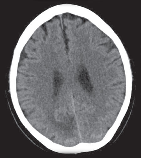 Figura 1 – TC craneal sin contraste: hipodensidad en la sustancia blanca occipital derecha, compatible con edema; hallazgo compatible con LOE intraaxial occipital derecha, sin poder descartar infarto occipital subagudo.