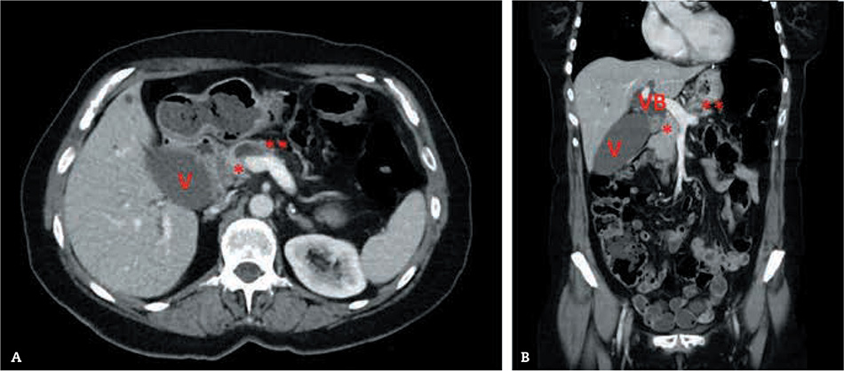 Figura 1 – Visión axial (A) y coronal (B) de la TC abdominal donde se pone de manifiesto la vesícula (V) y vía biliar (VB) dilatadas debido a un tumor de cabeza pancreática que impronta en el eje venoso mesentericoportal (*) y condiciona una dilatación del conducto de Wirsung (**) sobre la confluencia portal de las venas esplénica y mesentérica.