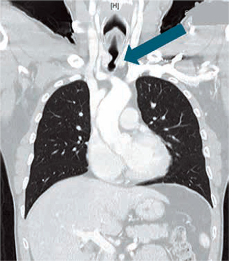 Figura 3 – TAC Torácico, en ventana pulmonar, con visualización de estenosis traqueal (flecha azul).