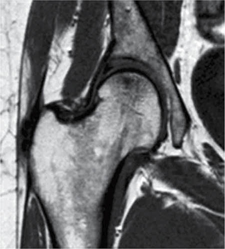 Figura 1 – RMN de la cadera derecha: edema y osteonecrosis.