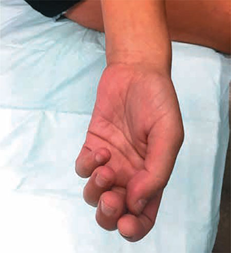 Figura 2 – Imposibilidad para la extensión de los cuatro últimos dedos asociada a extensión y abducción del pulgar.