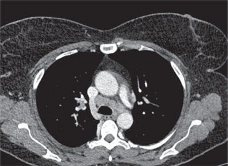 Figura 6 – Corte transversal de TC de tórax: adenopatías mediastínicas de tamaño patológico.