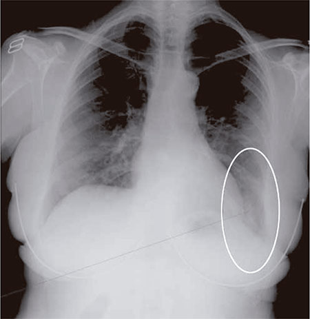 Figura 2 – Radiografía de tórax posteroanterior (3 de abril): misma imagen que anterior pero invertida. Se aprecian infiltrados alveolo-intersticiales en la periferia del campo medio pulmonar izquierdo y probable afectación basal del lóbulo inferior del mismo lado.