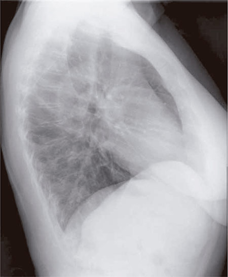 Figura 4 – Radiografía de tórax lateral (14 de mayo): sin alteraciones parenquimatosas.