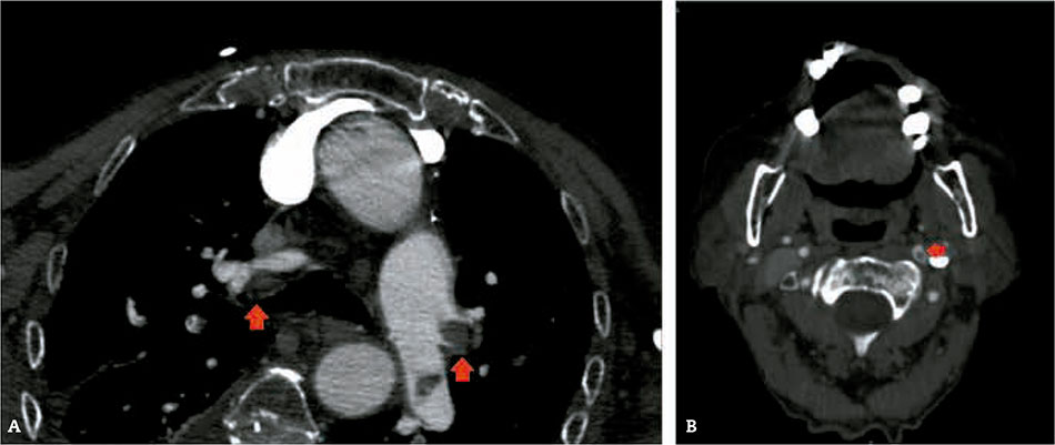 Figura 1 – A) Angio-TAC de tórax: se aprecia imagen compatible con trombos bilaterales en ambas arterias pulmonares.   B) Angio-TAC de cráneo: se aprecia imagen compatible con trombo hemisférico izquierdo.