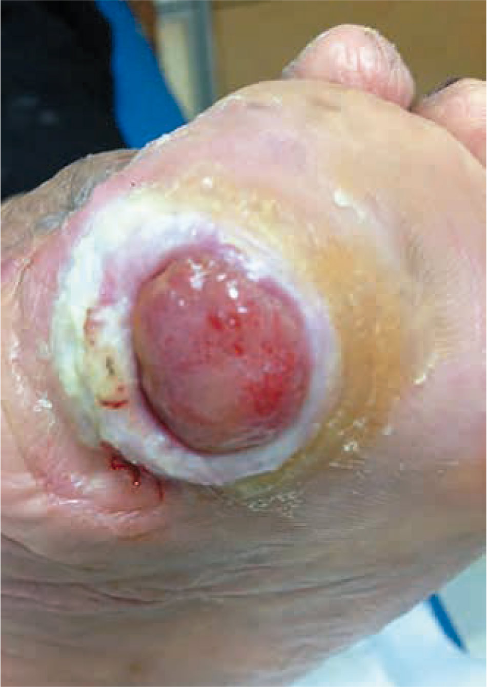 Figura 1 – Úlcera con 20 días de evolución.