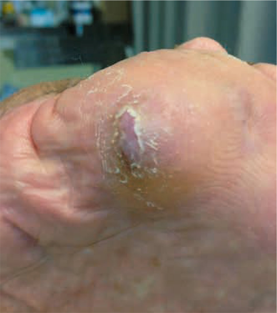 Figura 3 – Úlcera curada tras 5 meses de tratamiento. 