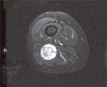 Figura 1 – RMN: corte transversal del miembro inferior derecho. Tumoración de estirpe neural de unos 40 mm de diámetro mayor. 
