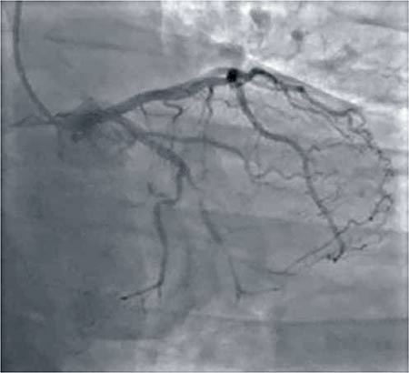 Figura 3 – Lesión arteria circunfleja en angiografía.