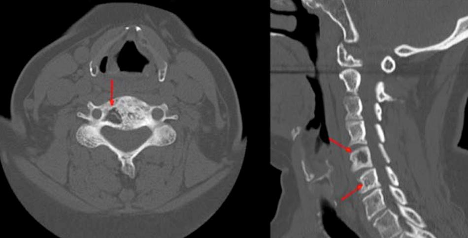 Figura 1 – TC simple cervical (corte axial y sagital): se aprecian los hallazgos radiológicos característicos, con áreas líticas y escleróticas en los cuerpos vertebrales C5 y C6.