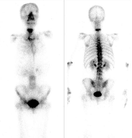Figura 2 – Gammagrafía corporal total con tecnecio-99m: se aprecia hipercaptación de contraste en los cuerpos vertebrales C5 y C6.
