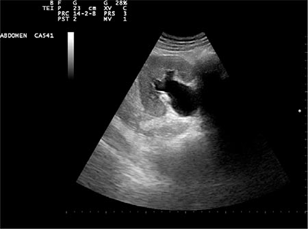 Figura 1 – Se observa marcada dilatación pielocalicial en el riñón derecho junto con adelgazamiento del parénquima renal.