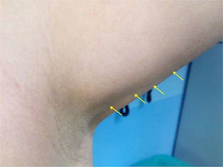 Figura 1 – Cordón palpable subcutáneo en el hueco axilar, de unos 3 cm de longitud y unos 2-3 mm de grosor; se extiende de forma parcialmente visible hacia el tercio medio de la cara interna del brazo.