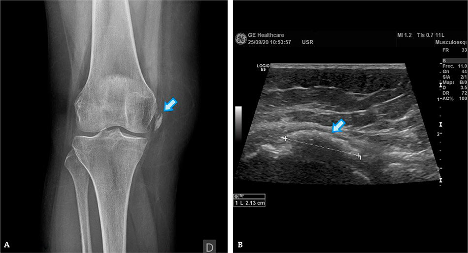 Figura 4 – A) Radiografía simple de rodilla: calcificación en ligamento colateral interno del fémur (flecha), muy disminuida tras infiltración. B) Ecografía de la calcificación del ligamento colateral interno del femur en el síndrome de Pellegrini-Stieda (flecha). Diámetros: 21 x 18 mm.
