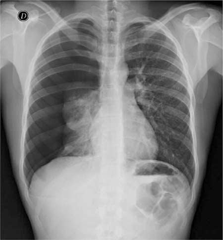 Figura 1 – Radiografía anteroposterior de tórax. Véase neumotórax.