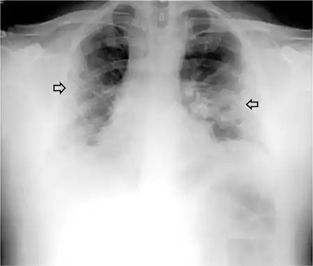 Figura 1 – Radiografía de tórax póstero-anterior: aumento de densidad de tipo intersticial bilateral de predominio en las bases (flechas).