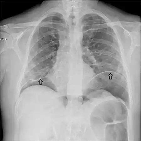 Figura 3 – Radiografía de tórax póstero-anterior en bipedestación: neumoperitoneo (flechas) y presencia de aumento de densidad tenue de tipo intersticial en ambos hemitórax.