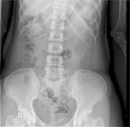 Figura 3 – Radiografía simple del abdomen: calcificación vesical sutil ínfero-izquierda.
