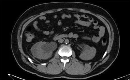 Figura 3 – TAC abdominal: hidronefrosis en el riñón derecho.