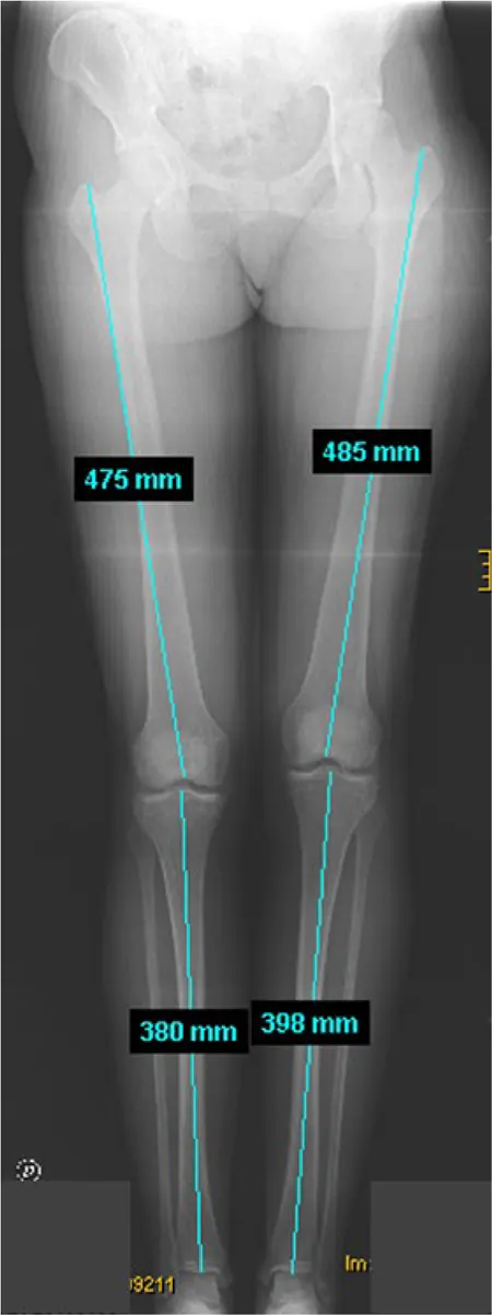 Figura 2 – Radiografía de mensuración de miembros inferiores, en la que se aprecia mayor longitud del fémur y la tibia izquierdos.