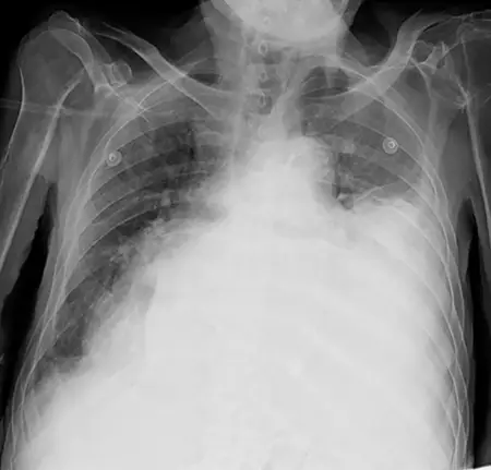 Figura 1– Radiografía de tórax: radiopacidad homogénea que ocupa los dos tercios inferiores del campo pulmonar izquierdo y borra la silueta cardiaca.