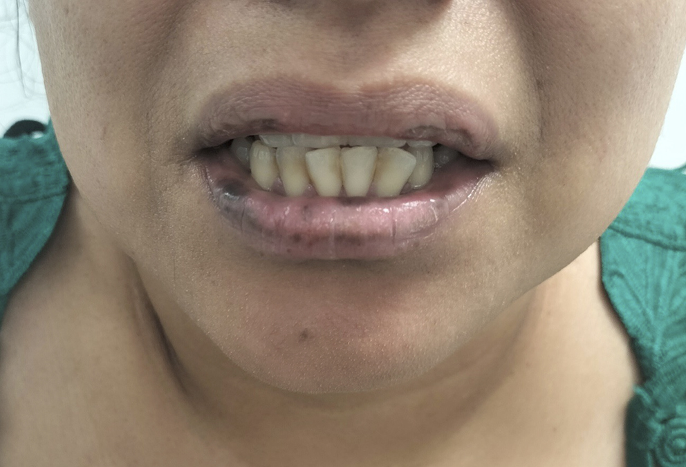 fig1_89-91-15n2 Figura 1 – Lesiones maculares melanocíticas en los labios propias del síndrome de Laugier-Hunziker