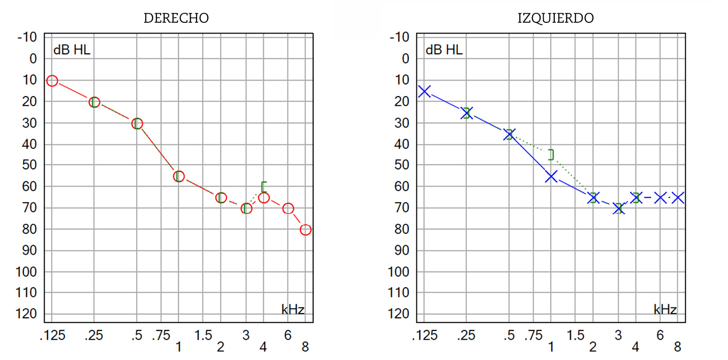 fig1_92-94-15n2 Figura 1 – Hipoacusia neurosensorial: ambas líneas (vía ósea y vía aérea) se superponen y se produce una caída por debajo de los 30 dB.