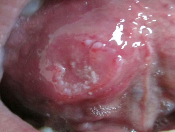 fig1_191_192_15n4 Figura 1 – Lesión excrecente y ulcerada en la cara ventral derecha de la lengua, compatible con carcinoma escamoso de la lengua.